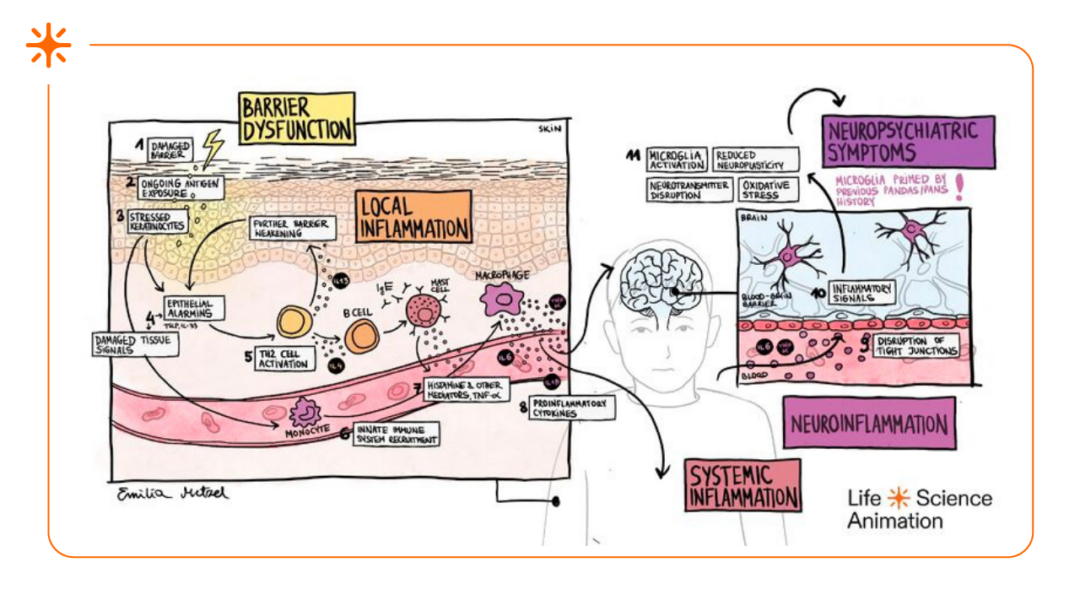 Illustration showing how skin barrier dysfunction and inflammation can lead to systemic inflammation, neuroinflammation, and neuropsychiatric symptoms such as PANS/PANDAS.